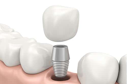 Dental Implants | 1 | Uptown Dental Associates | Albuquerque, NM
