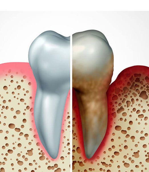 Chao Pinhole® Surgical Technique - Uptown Dental Associates