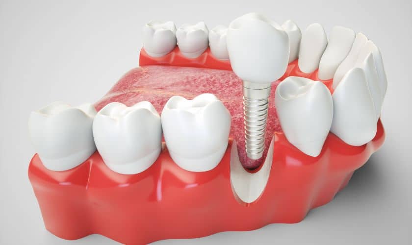 Dental Implants in Albuquerque - Uptown Dental Associates